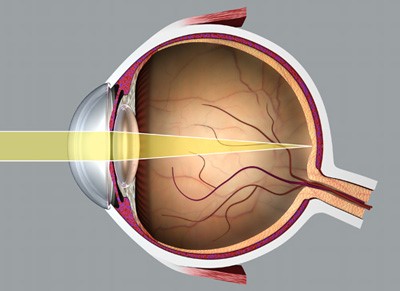 retina szem leválás kezelés során a diabetes)